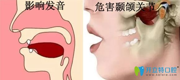 牙齒缺失影響發(fā)音及顳頜關(guān)節(jié)