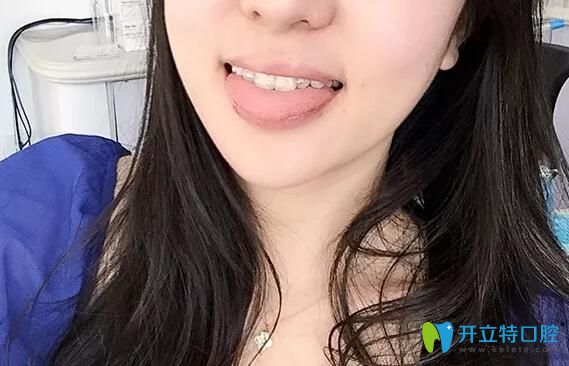 在深圳韋博口腔做齙牙矯正1年半效果