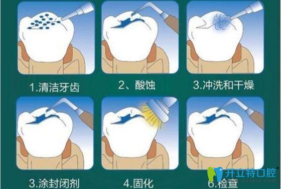 窩溝封閉的過程圖解