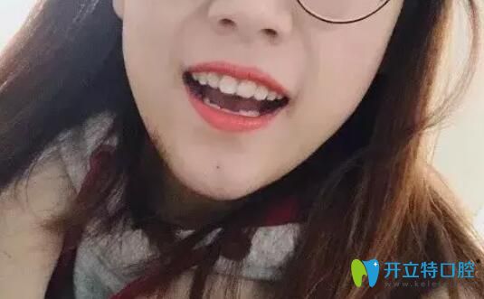 多生牙做牙齒矯正后效果圖照片