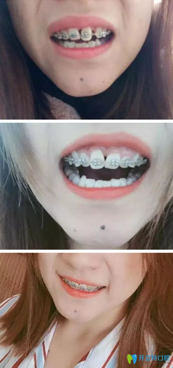 牙齒矯正過程中變化圖