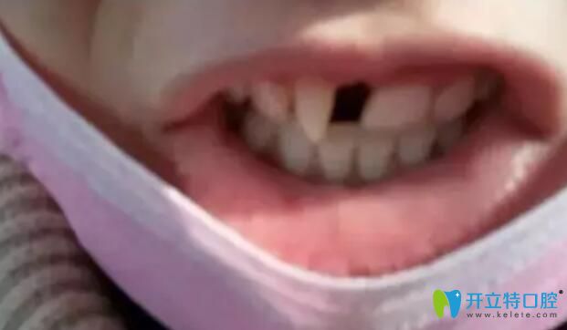 牙齒矯正前拔牙