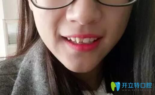 矯正多生牙對(duì)比圖來啦，在寧波牙博士做鋼絲矯正效果不賴