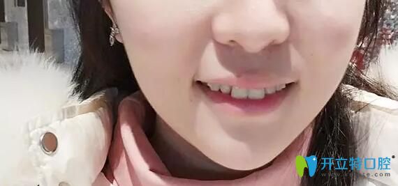 在深圳韋博口腔做牙齒矯正6個月