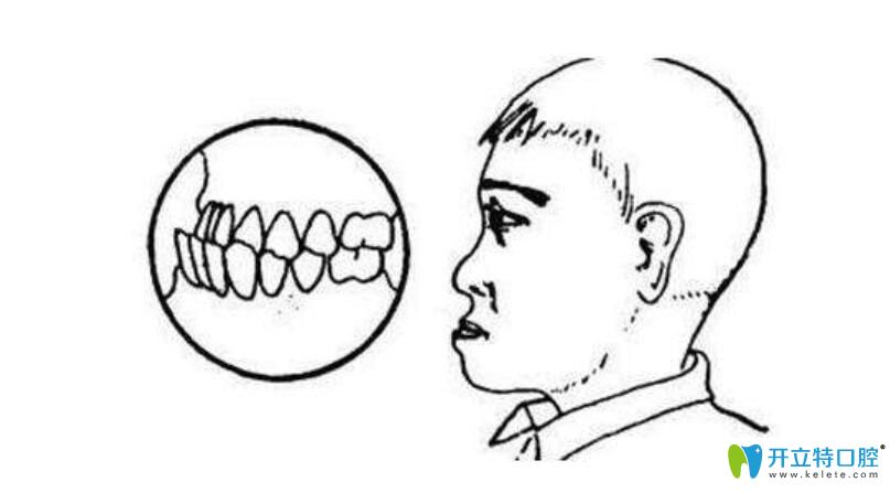 牙齒反合=地包天？如果不幸遭遇牙齒反合是不是一定要矯正