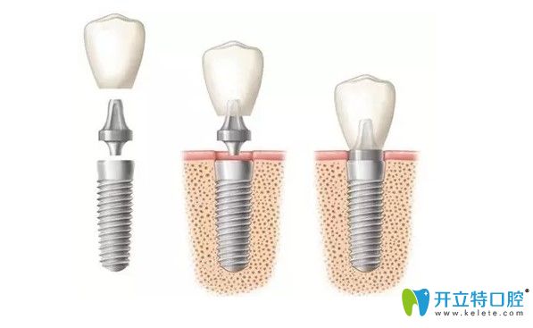 微創(chuàng)即刻種植牙技術(shù)圖示