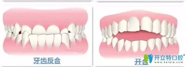 牙齒地包天和開(kāi)合圖示 牙齒地包天和開(kāi)合圖示