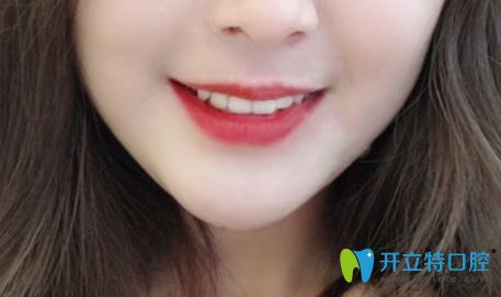 花2萬多元在珠海九龍口腔做的隱形矯正效果