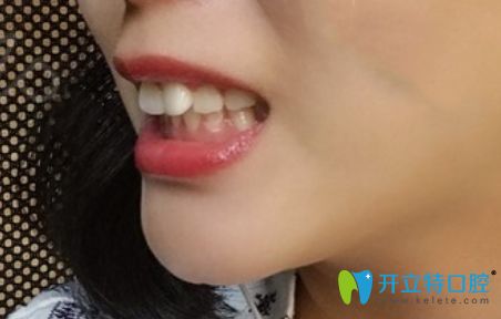 珠海牙齒矯正價(jià)格參差不齊,我在九龍口腔做隱形矯正是2萬起