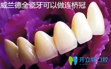 威蘭德全瓷牙可以做多顆連橋冠