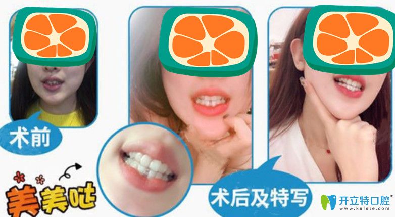 隱適美隱形矯正案例圖