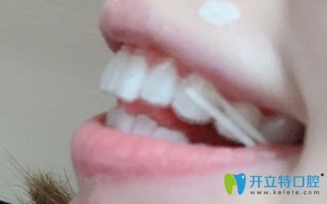 戴隱形牙套矯正一年的效果圖