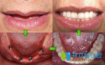 趙阿姨在昆明尚愛韓美口腔做完種植牙的圖片