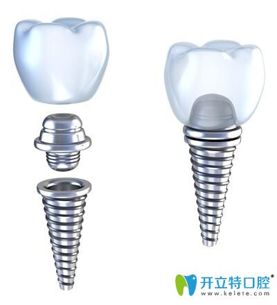 瑞士ITI種植體一段式和兩段式