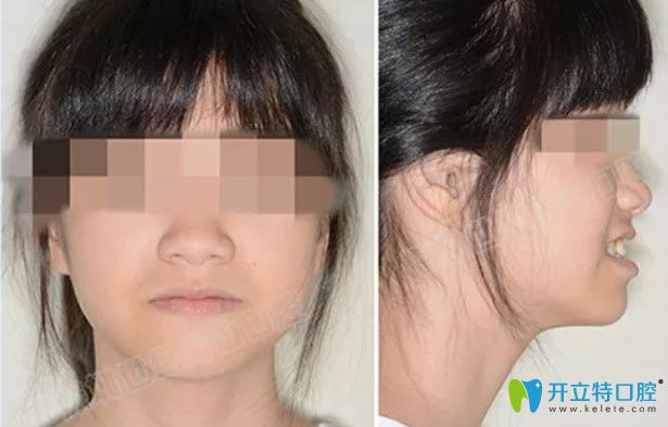 來瞅瞅13歲虎牙妹在深圳世紀(jì)河山口腔做的金屬自鎖矯正效果