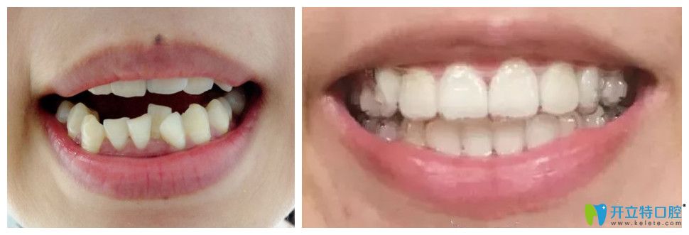 通過(guò)真人案例效果來(lái)判斷適美樂(lè)隱形正畸怎么樣