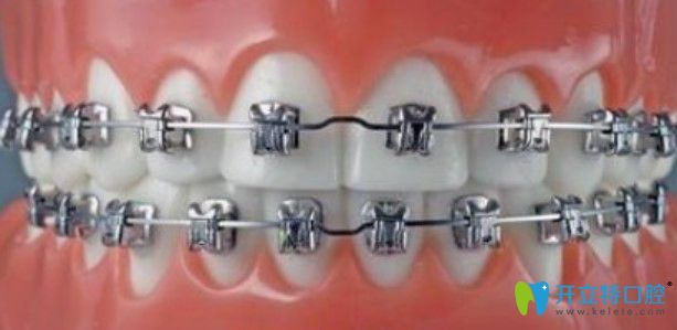 金屬自鎖托槽矯正圖示