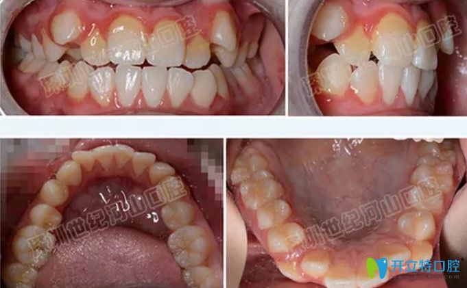 沒做矯正之前的牙齒情況圖