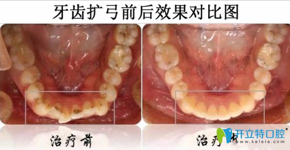 牙齒擴(kuò)弓前后效果對比圖