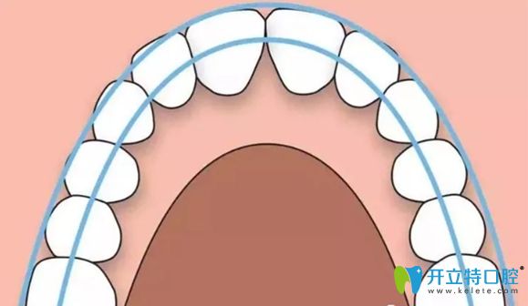 擴(kuò)弓的作用就是為了讓牙齒變的整齊