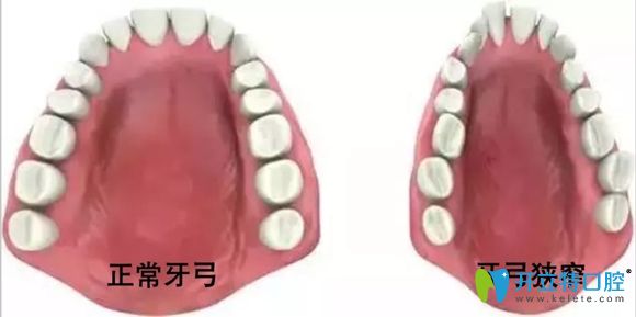 醫(yī)生:同學說她擴弓十天臉變了,牙齒擴弓臉會變寬變大真的嗎