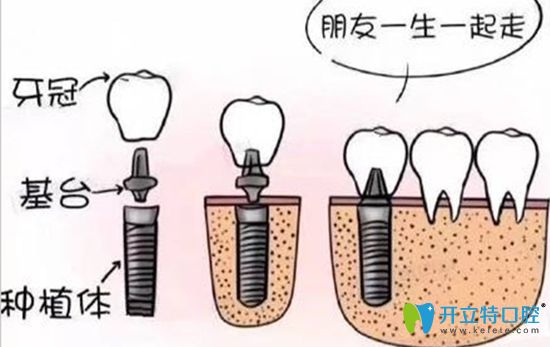 種植牙安裝基臺(tái)是不會(huì)有太大痛感