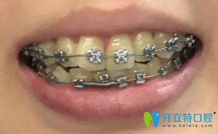 牙齒矯正3個(gè)月時(shí)的效果 牙齒矯正3個(gè)月時(shí)的效果