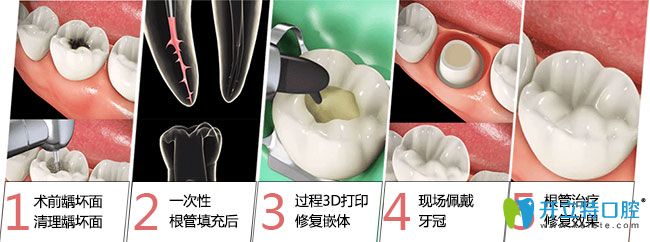 南京博韻口腔魏厚星醫(yī)生介紹根管治療注意事項