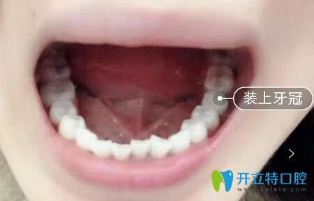 我在深圳諾德口腔做瑞士ITI種植牙后效果