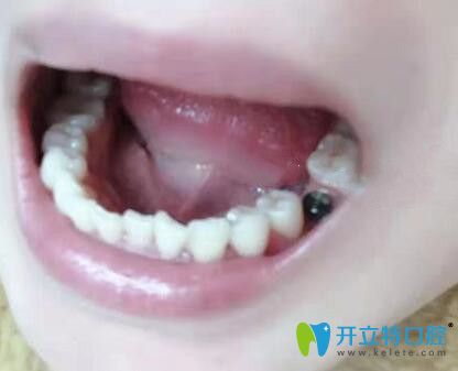 在深圳諾德口腔植入種植體