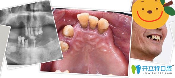 沒有來廣州廣大口腔做種植牙前
