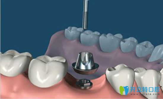 種植牙基臺(tái)是什么