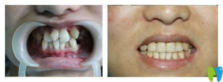 華美口腔—錢阿姨矯正牙齒親身實例