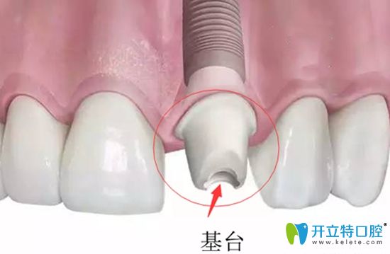 想弄清種植牙基臺(tái)是什么?安裝基臺(tái)疼不疼?戳進(jìn)來(lái)看看就知道