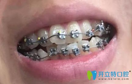 聽說深圳南山區(qū)好的牙科是好佰年口腔,正畸體驗后來分享