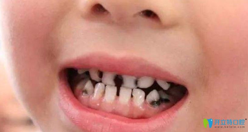 楊景醫(yī)生展示寶寶爛牙圖