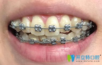 牙齒矯正半年效果圖 牙齒矯正半年效果圖