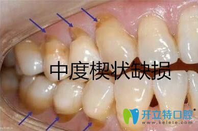 中度牙齒楔狀缺損