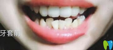 深圳諾德齒科牙齒矯正價(jià)格真不貴,我做的隱形矯正15800元起