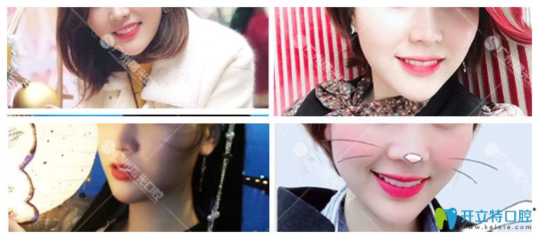 齙牙妹在曙光口腔矯正牙齒效果圖 齙牙妹在曙光口腔矯正牙齒效果圖