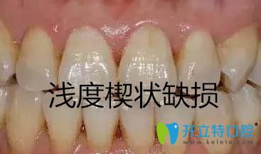 淺度牙齒楔狀缺損