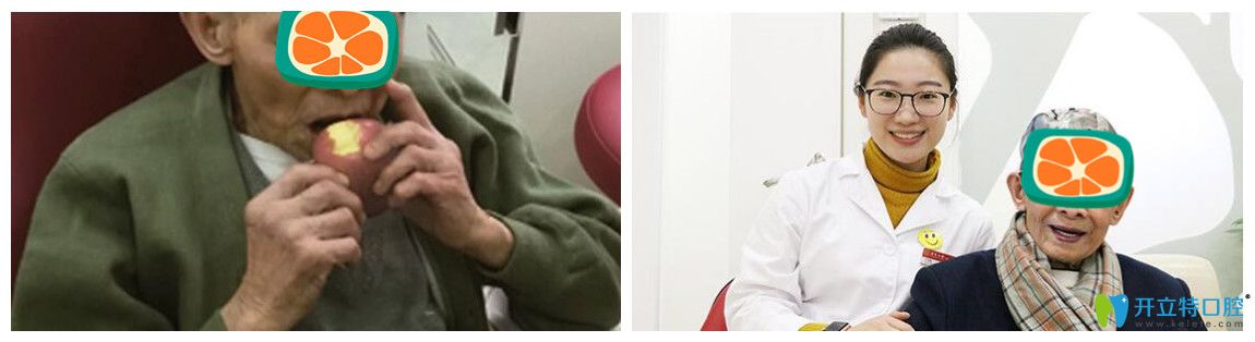 廣州廣大口腔的韓重聲老人做種植牙之后的留影