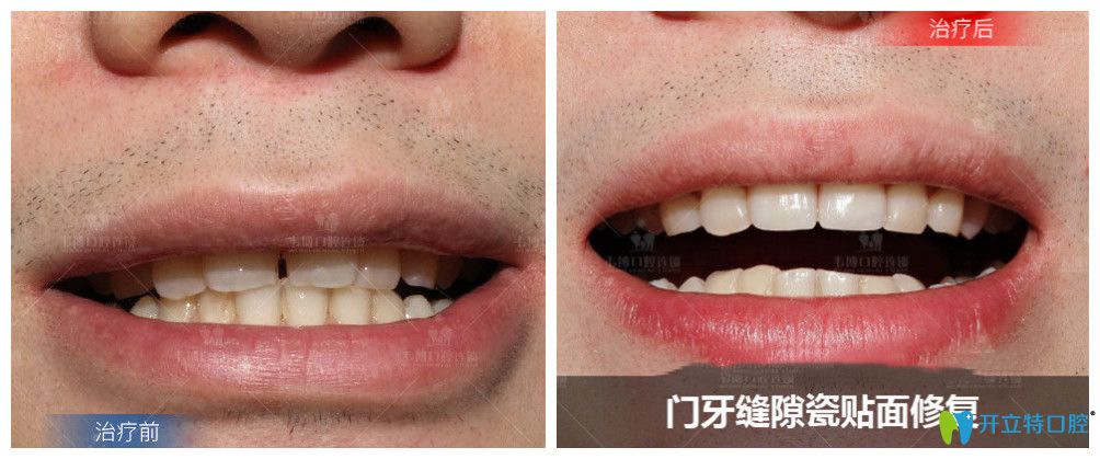 門牙縫隙大的小哥哥就做了瓷貼面修復