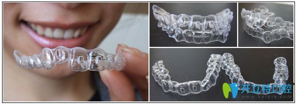 北京瑞鯊口腔張嘉熙醫(yī)生介紹時代天使雙模和單模的區(qū)別 北京瑞鯊口腔張嘉熙醫(yī)生介紹時代天使雙模和單模的區(qū)別