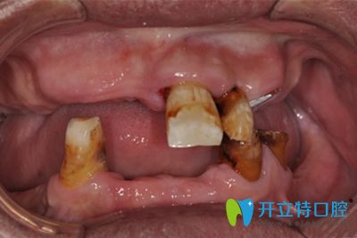 幾番對比,老爸在慈溪鼎植口腔(紅兔)做了all-on-4全口種植牙