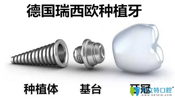 詳解德國進口種植牙品牌:瑞西歐ht種植體的優(yōu)勢和價格