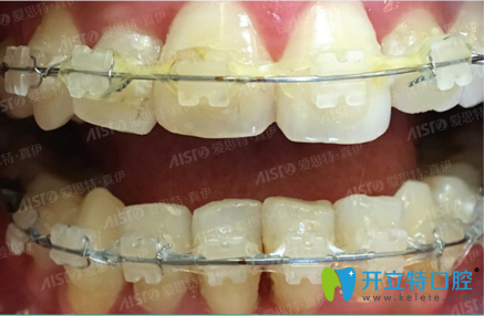 在愛思特口腔戴陶瓷托槽矯正牙齒術(shù)中照 在愛思特口腔戴陶瓷托槽矯正牙齒術(shù)中照