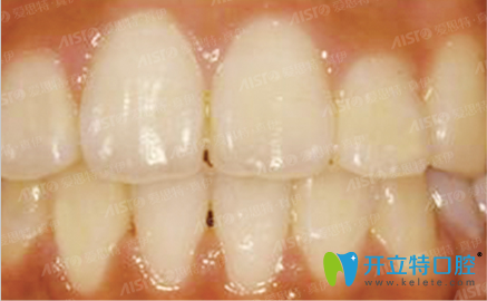 在重慶愛思特口腔做牙齒矯正后的效果圖 在重慶愛思特口腔做牙齒矯正后的效果圖