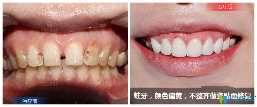 ↓蛀牙、顏色偏黃，不整齊做了瓷貼面修復后牙齒大變樣