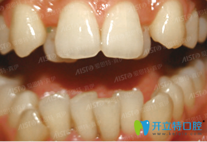 我的兩顆門(mén)牙突出,在重慶愛(ài)思特口腔做陶瓷托槽矯正改善了